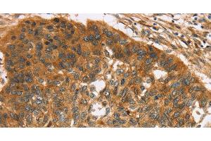 Immunohistochemistry of paraffin-embedded Human esophagus cancer using TNFSF15 Polyclonal Antibody at dilution of 1:40 (TNFSF15 anticorps)