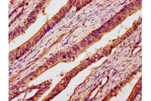 IHC image of ABIN7142974 diluted at 1:100 and staining in paraffin-embedded human colon cancer performed on a Leica BondTM system.