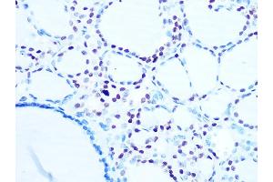 Immunohistochemistry of paraffin-embedded human thyroid cancer using Histone H1. (Histone H1 anticorps)