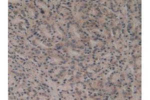 Detection of Flt3 in Human Prostate Gland Cancer Tissue using Polyclonal Antibody to FMS Like Tyrosine Kinase 3 (Flt3)