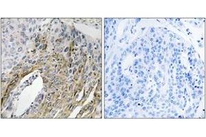 Immunohistochemistry analysis of paraffin-embedded human lung carcinoma tissue, using LONP2 Antibody.