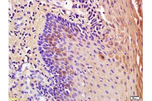 Formalin-fixed and paraffin embedded human oral squamous cell carcinoma labeled with Anti-IL-1RA Polyclonal Antibody, Unconjugated (ABIN678743) at 1:200 followed by conjugation to the secondary antibody and DAB staining
