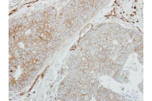 IHC-P Image Immunohistochemical analysis of paraffin-embedded human colon carcinoma, using HLA-DMB, antibody at 1:250 dilution.