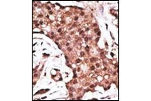 Formalin-Fixed, Paraffin-Embedded human cancer tissue reacted with ATG5 Antibody (N-term) followed which was peroxidase conjugated to the secondary antibody, followed by DAB staining.