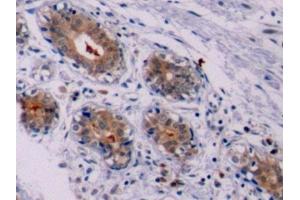 Detection of Bcl2 in Human Breast cancer Tissue using Polyclonal Antibody to B-Cell Leukemia/Lymphoma 2 (Bcl2)