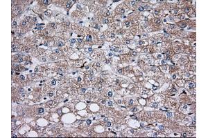 Immunohistochemical staining of paraffin-embedded Carcinoma of Human prostate tissue using anti-TBXAS1 mouse monoclonal antibody. (TBXAS1 anticorps)