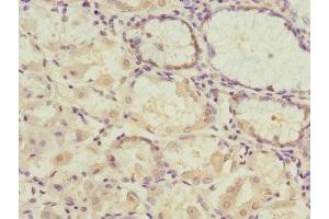 Immunohistochemistry of paraffin-embedded human gastric cancer using ABIN7166902 at dilution of 1:100