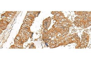 Immunohistochemistry of paraffin-embedded Human colorectal cancer tissue using GOLGA6A Polyclonal Antibody at dilution of 1:50(x200) (GOLGA6A anticorps)