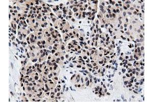 Immunohistochemical staining of paraffin-embedded Carcinoma of Human lung tissue using anti-NT5DC1 mouse monoclonal antibody. (NT5DC1 anticorps)