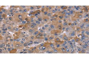 Immunohistochemistry of paraffin-embedded Human liver cancer using NCF2 Polyclonal Antibody at dilution of 1:60 (NCF2 anticorps)