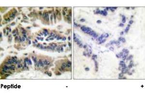Immunohistochemical analysis of paraffin-embedded human breast carcinoma tissue using CASP6 polyclonal antibody . (Caspase 6 anticorps)