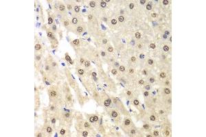 Immunohistochemistry of paraffin-embedded human liver cancer using ETS1 antibody (ABIN5970774) at dilution of 1/100 (40x lens). (ETS1 anticorps)