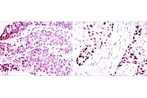 Immunohistochemical analysis of paraffin-embedded ovarian cancer (left) and lung cancer (right) using p63α mouse mAb with DAB staining. (p63alpha anticorps)