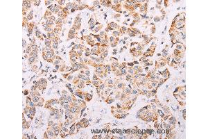 Immunohistochemistry of Human colon cancer using ADAMTS16 Polyclonal Antibody at dilution of 1:50 (ADAMTS16 anticorps)