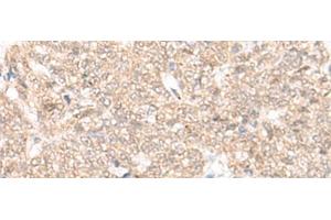 Immunohistochemistry of paraffin-embedded Human ovarian cancer tissue using FAM111B Polyclonal Antibody at dilution of 1:25(x200) (FAM111B anticorps)