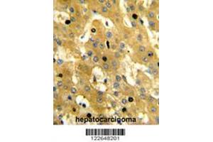 Formalin-fixed and paraffin-embedded human hepatocarcinoma reacted with SCP2 Antibody (Center), which was peroxidase-conjugated to the secondary antibody, followed by DAB staining. (SCP2 anticorps  (Middle Region))