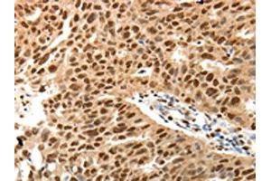 The image on the left is immunohistochemistry of paraffin-embedded Human ovarian cancer tissue using ABIN7131160(SPATA2L Antibody) at dilution 1/30, on the right is treated with fusion protein. (SPATA2L anticorps)