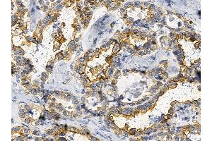 Annexin A2 Mouse Monoclonal Antibody at 1/100 staining human ovarian cancer by IHC-P.