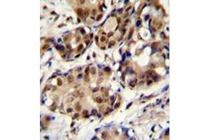 Formalin fixed and paraffin embedded human breast carcinoma stained with PELP1 Antibody (Center) followed by peroxidase conjugation of the secondary antibody and DAB staining. (PELP1 anticorps  (Middle Region))