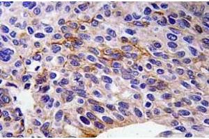 Immunohistochemistry (IHC) analyzes of SEMA3A antibody in paraffin-embedded human lung carcinoma tissue. (SEMA3A anticorps)