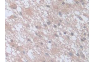 Detection of SNAP23 in Human Glioma Tissue using Polyclonal Antibody to Synaptosomal Associated Protein 23 kDa (SNAP23)