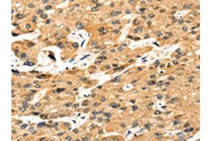 The image on the left is immunohistochemistry of paraffin-embedded Human liver cancer tissue using ABIN7131243(STX8 Antibody) at dilution 1/35, on the right is treated with fusion protein. (STX8 anticorps)