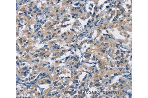 Immunohistochemistry of Human thyroid cancer using APOL1 Polyclonal Antibody at dilution of 1:40 (APOL1 anticorps)