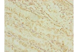 Immunohistochemistry of paraffin-embedded human gastric cancer using ABIN7164317 at dilution of 1:100