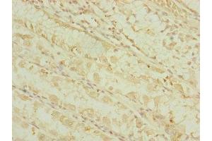Immunohistochemistry of paraffin-embedded human gastric cancer using ABIN7164317 at dilution of 1:100 (DHTKD1 anticorps  (AA 1-280))