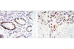 Immunohistochemical analysis of paraffin-embedded colon cancer tissues (left) and lung cancer tissues (right) using KLF4 mouse mAb with DAB staining (KLF4 anticorps)