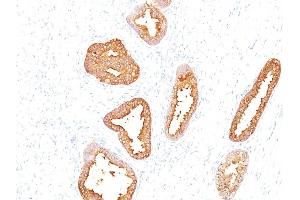 Formalin-fixed, paraffin-embedded human Prostate Carcinoma stained with PSA Mouse Monoclonal Antibody (A67-B/E3). (Prostate Specific Antigen anticorps)