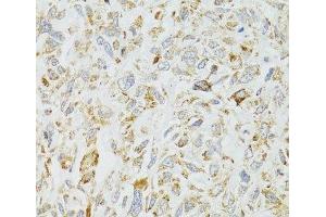 Immunohistochemistry of paraffin-embedded Human lung cancer using DICER1 Polyclonal Antibody at dilution of 1:100 (40x lens). (DICER1 anticorps)