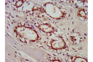 IHC image of ABIN7154777 diluted at 1:800 and staining in paraffin-embedded human breast cancer performed on a Leica BondTM system. (GBP4 anticorps  (AA 494-603))