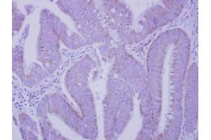 IHC-P Image Immunohistochemical analysis of paraffin-embedded human colon carcinoma, using Integrin alpha V, antibody at 1:250 dilution.
