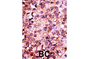 Formalin-fixed and paraffin-embedded human cancer tissue reacted with the primary antibody, which was peroxidase-conjugated to the secondary antibody, followed by AEC staining.
