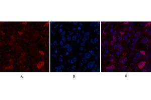 Immunofluorescence analysis of human breast cancer tissue.