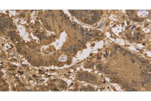 Immunohistochemistry of paraffin-embedded Human colon cancer tissue using KDM5B Polyclonal Antibody at dilution 1:40 (KDM5B anticorps)