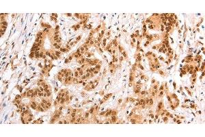Immunohistochemistry of paraffin-embedded Human colon cancer tissue using TAX1BP1 Polyclonal Antibody at dilution 1:60 (TAX1BP1 anticorps)