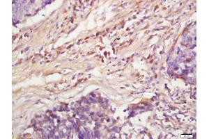 Formalin-fixed and paraffin embedded human lung carcinoma labeled with Anti-Phospho-MAPKAPK2(Ser272)Polyclonal Antibody, Unconjugated (ABIN710531) at 1:200, followed by conjugation to the secondary antibody and DAB staining