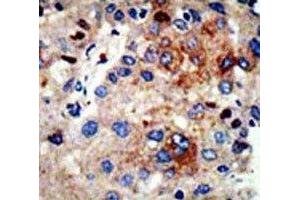 IHC analysis of FFPE human hepatocarcinoma stained with HDAC9 antibody