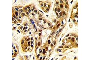 IHC analysis of FFPE human breast carcinoma tissue stained with PRMT1 antibody (PRMT1 anticorps  (AA 317-346))