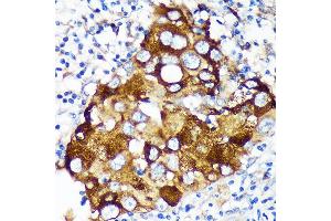 Immunohistochemistry of paraffin-embedded Human breast cancer using WIF1 Rabbit pAb (ABIN6128926, ABIN6150217, ABIN6150219 and ABIN6216799) at dilution of 1:100 (40x lens). (WIF1 anticorps  (AA 29-220))