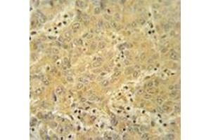 Immunohistochemistry analysis in human hepatocarcinoma tissue (Formalin-fixed, Paraffin-embedded) using CYP2A7  Antibody , followed by peroxidase conjugation of the secondary antibody and DAB staining. (CYP2A7 anticorps  (Middle Region))