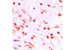 Immunohistochemical analysis of FOSL1 staining in human lung cancer formalin fixed paraffin embedded tissue section. (FOSL1 anticorps  (Center))