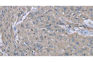 Immunohistochemistry of paraffin-embedded Human esophagus cancer using EZR Polyclonal Antibody at dilution of 1:30