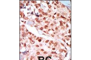 Formalin-fixed and paraffin-embedded human cancer tissue reacted with the primary antibody, which was peroxidase-conjugated to the secondary antibody, followed by DAB staining.