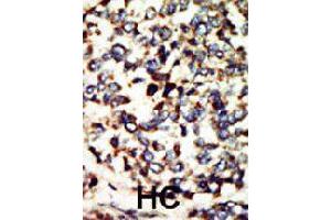Formalin-fixed and paraffin-embedded human hepatocellular carcinoma tissue reacted with NEK7 polyclonal antibody  , which was peroxidase-conjugated to the secondary antibody, followed by DAB staining. (NEK7 anticorps  (N-Term))