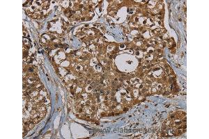 Immunohistochemistry of Human breast cancer using PNN Polyclonal Antibody at dilution of 1:50 (PNN anticorps)