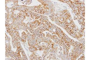 IHC-P Image Immunohistochemical analysis of paraffin-embedded N87 xenograft, using AP2M1, antibody at 1:100 dilution. (AP2M1 anticorps  (Center))