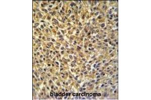 CRIP1 Antibody (C-term) (ABIN650905 and ABIN2839990) IHC analysis in formalin fixed and paraffin embedded bladder carcinoma followed by peroxidase conjugation of the secondary antibody and DAB staining. (CRIP1 anticorps  (C-Term))